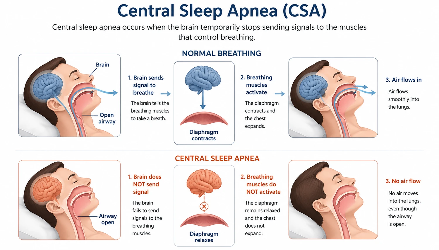 Diagram showing normal breathing vs Central Sleep Apnea (CSA)